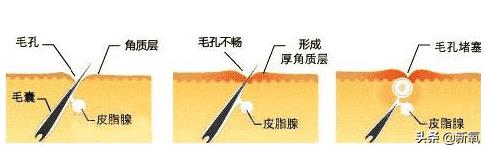 娥罗纳英软膏有什么作用（娥罗纳英h软膏）
