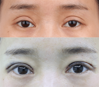 ​做双眼皮要花多少钱?怎么判断好不好 做双眼皮一共要花多少钱