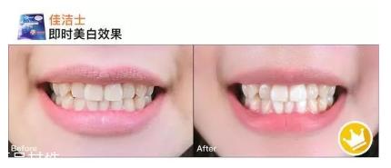 佳洁士一天美白牙贴真的能美白吗 佳洁士美白牙贴评测 佳洁士一天美白牙贴真的能美白吗 佳洁士美白牙贴评测