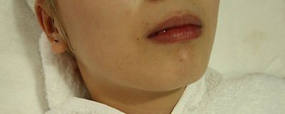 ​脸上白头怎么去除