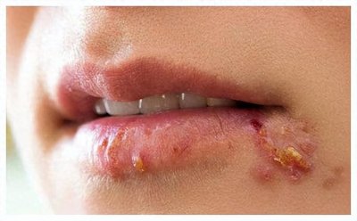 ​嘴巴周围起水泡？不只是上火的错，原因还有这些！
