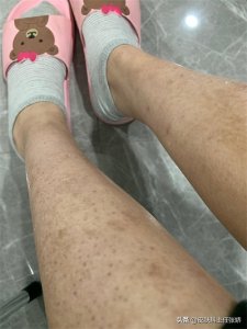 ​你了解鱼鳞病吗？